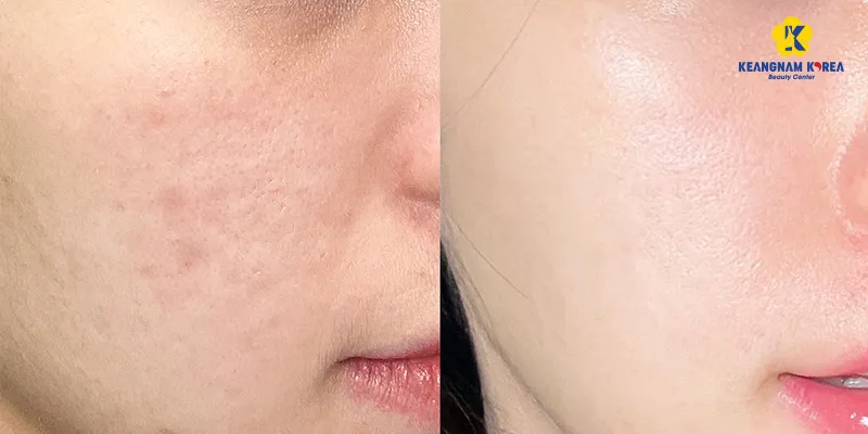 Công dụng của tiêm meso phục hồi da