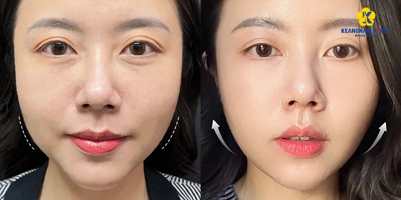 Công dụng của tiêm meso trắng da