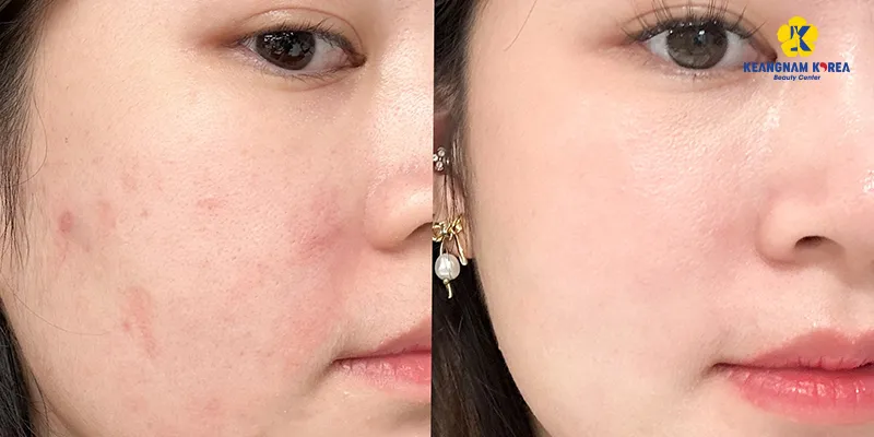 Công dụng của Meso trị sẹo và vết thâm