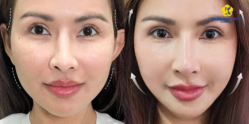 Công gudnjg cảu tiêm meso trẻ hóa da mặt
