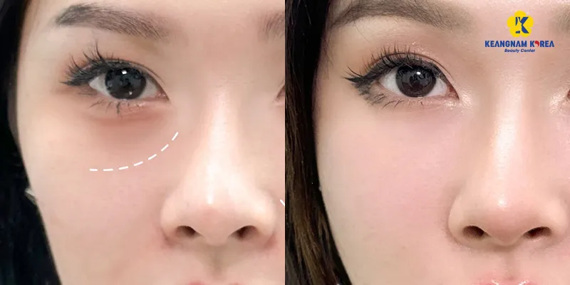 Công dụng của meso trị thâm mắt