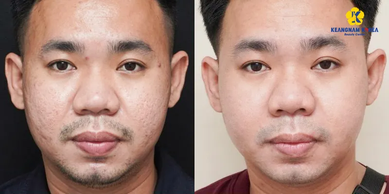 5 công nghệ điều trị sẹo rỗ tốt nhất hiện nay