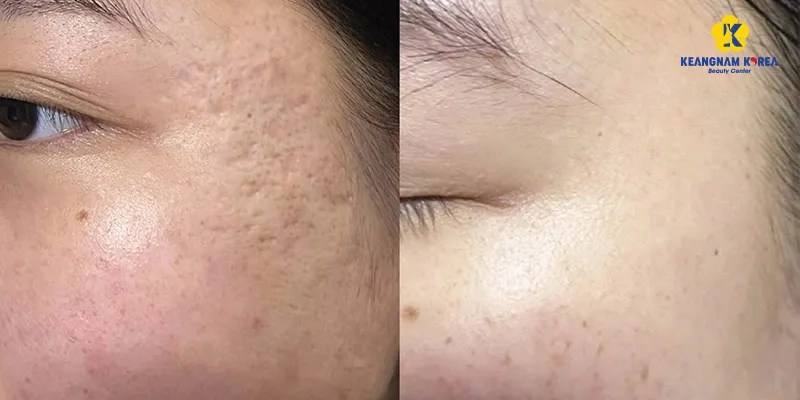 5 công nghệ điều trị sẹo rỗ tốt nhất hiện nay