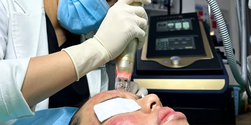 5 công nghệ điều trị sẹo rỗ tốt nhất hiện nay