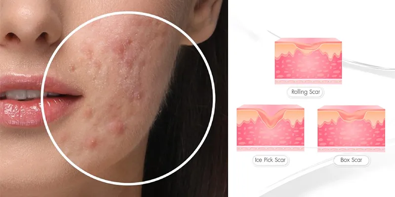 5 công nghệ điều trị sẹo rỗ tốt nhất hiện nay