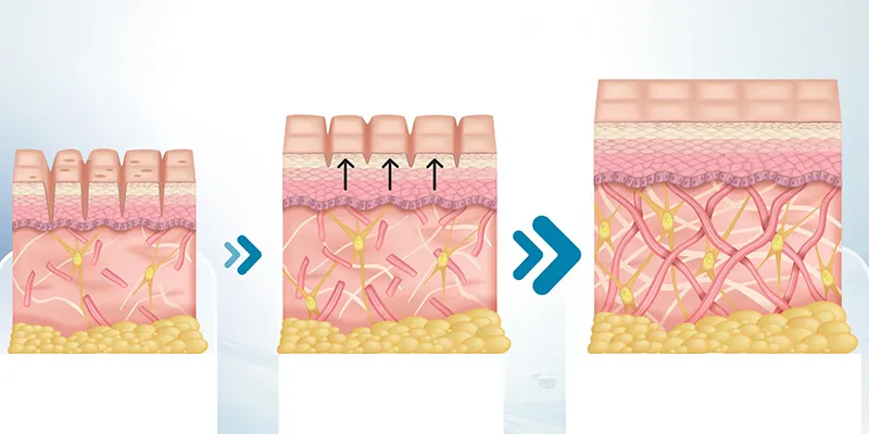 1 liệu trình trị sẹo rỗ tại Keangnam Korea giá bao nhiêu