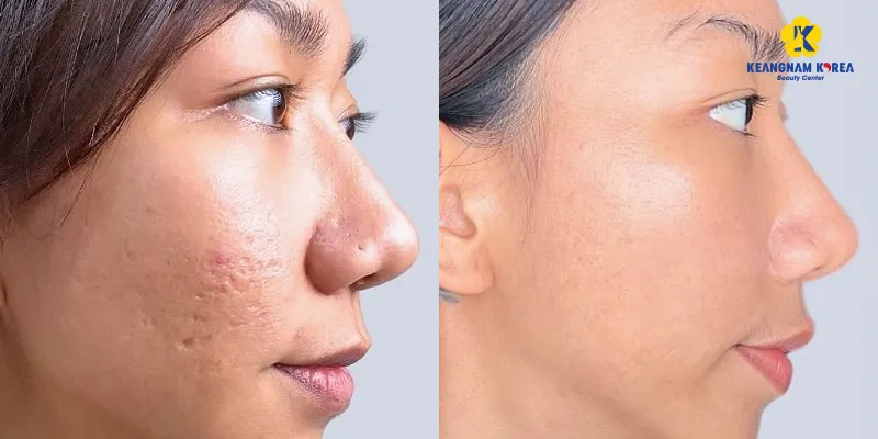 Nguyên nhân sẹo rỗ xuất hiện là gì