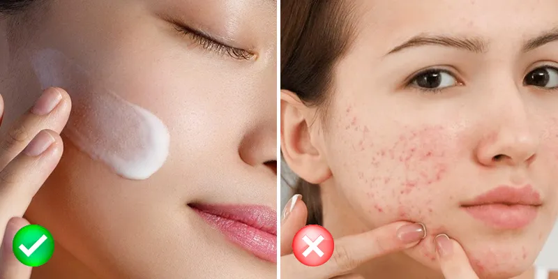 Nguyên nhân sẹo rỗ xuất hiện là gì