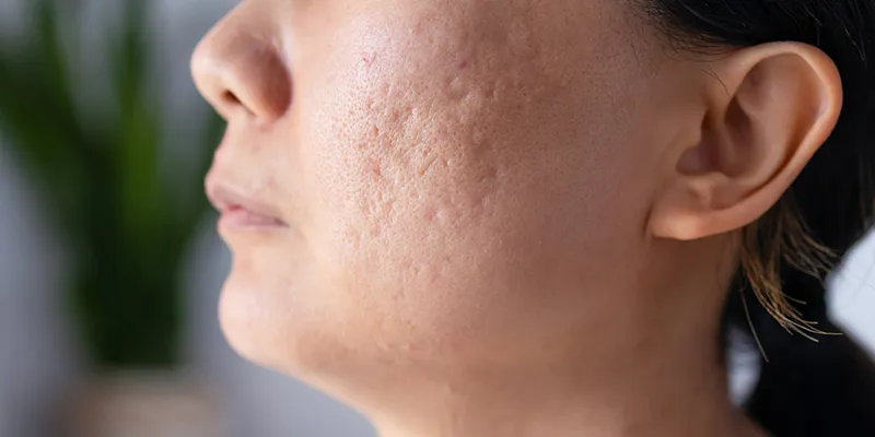 Nguyên nhân sẹo rỗ xuất hiện là gì
