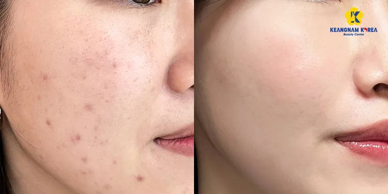 Phương pháp lăn kim trẻ hóa da là gì