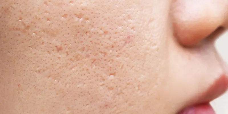 Sẹo rỗ có trị được không? 