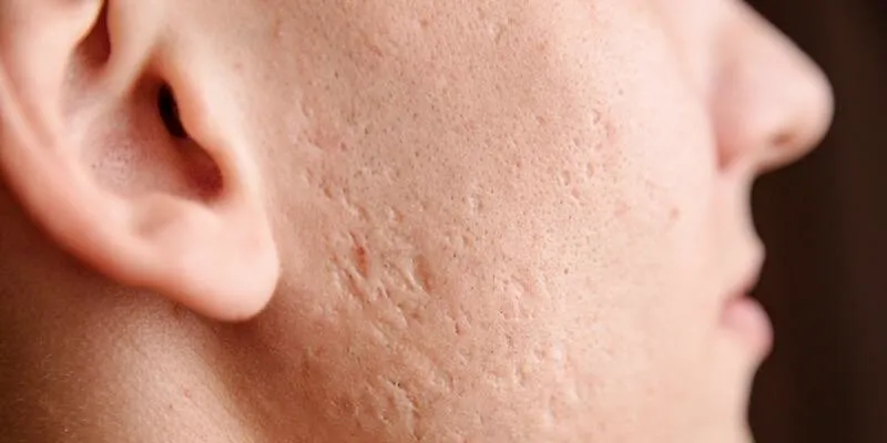 Sẹo rỗ có trị được không? 