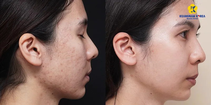 Sẹo rỗ có trị được không? 