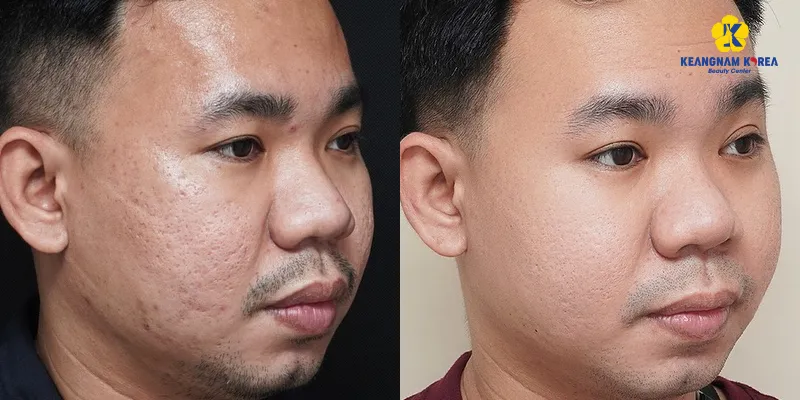 Sẹo rỗ có trị được không? 