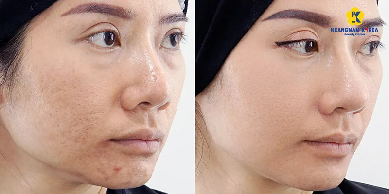 Sẹo rỗ nhẹ có hết không? 