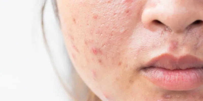 Sẹo rỗ nhẹ có hết không? 