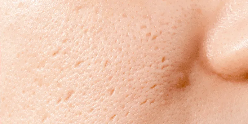 Sẹo rỗ nhẹ có hết không?
