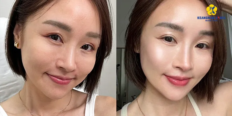 Hiệu quả của tiêm cấy meso trắng da là gì