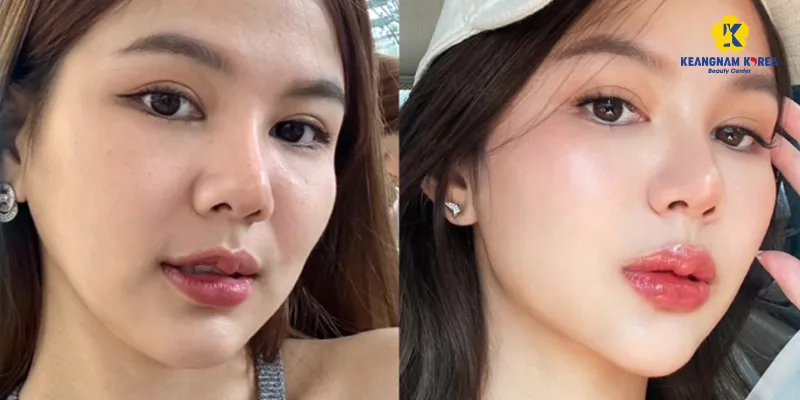 Hiệu quả của tiêm cấy meso trắng da là gì