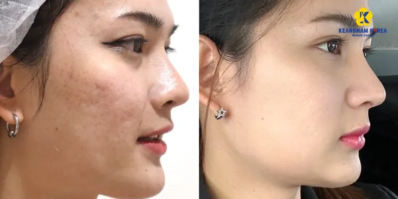 trị sẹo rỗ bằng phương pháp nào hiệu quả nhất