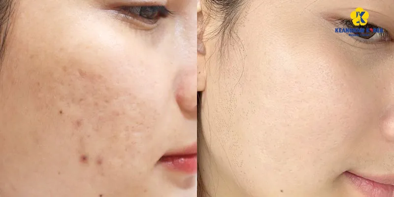 trị sẹo rỗ bằng phương pháp nào hiệu quả nhất