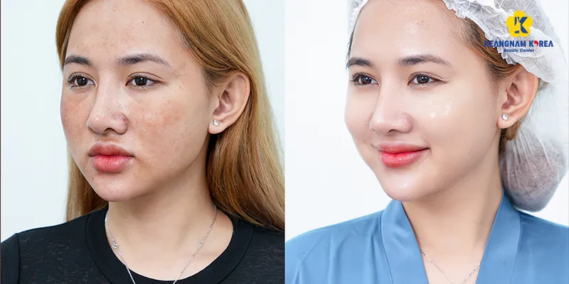 Các cách làm trắng da mặt tại nhà hiệu quả mà không hại da