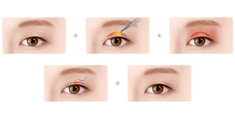 Các loại phẫu thuật thẩm mỹ mắt  