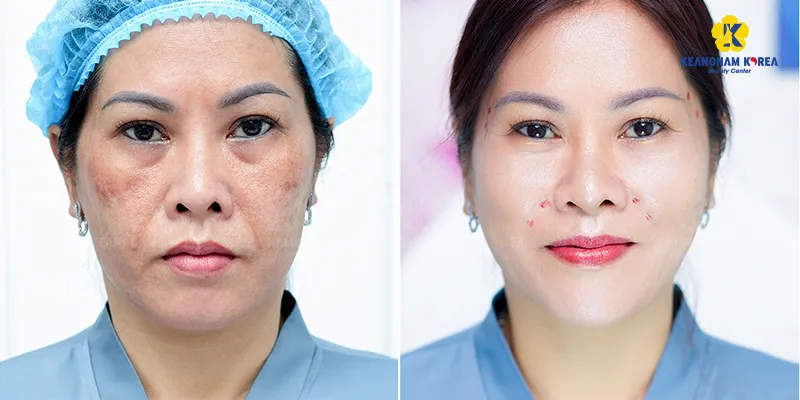 cách phục hồi da mặt bị hư tổn tại nhà