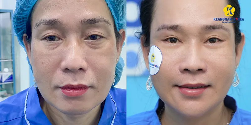 Quy trình cắt da chùng mí dưới là gì?