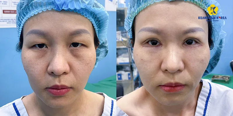 Quy trình cắt da chùng mí dưới là gì?