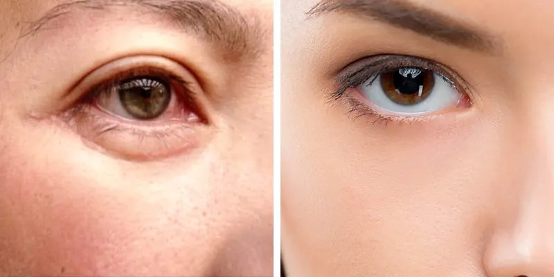 Cắt mí dưới có để lại sẹo không