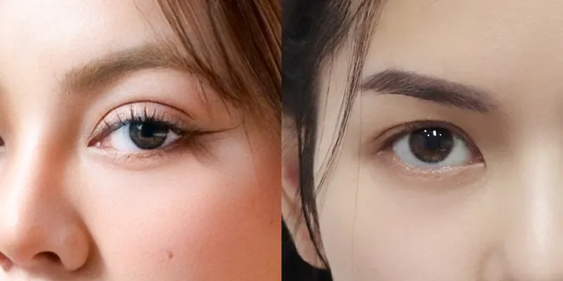 Cắt mí mắt có được vĩnh viễn không