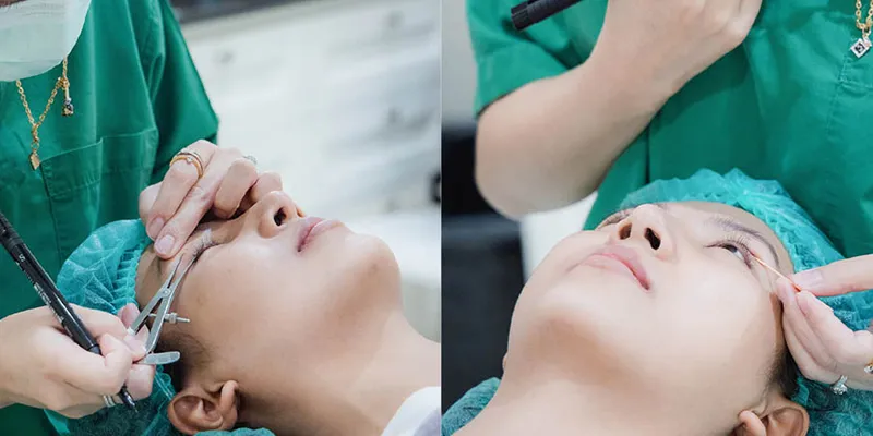 Cắt mí mắt có được vĩnh viễn không