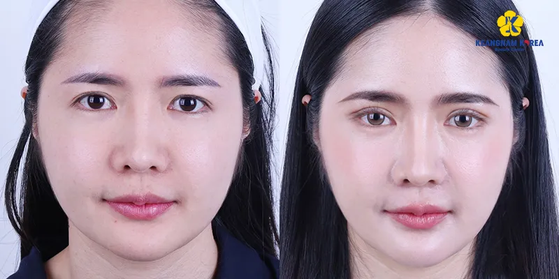 cắt mí mini và cắt mí full