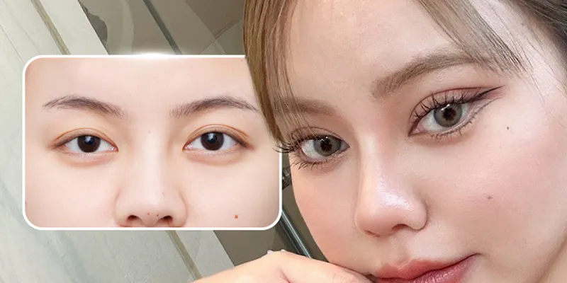cắt mí đuôi phượng là gì