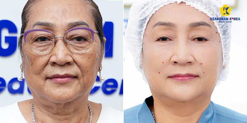 phục hồi làn da bị lão hóa
