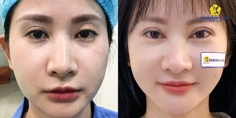 thẩm mỹ viện nào cắt mắt đẹp