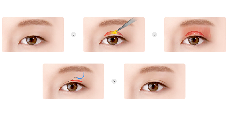 8 Types of Eyelid Plastic Surgery In Vietnam 3 eyelid plastic surgery