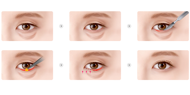 8 Types of Eyelid Plastic Surgery In Vietnam 4 eyelid plastic surgery