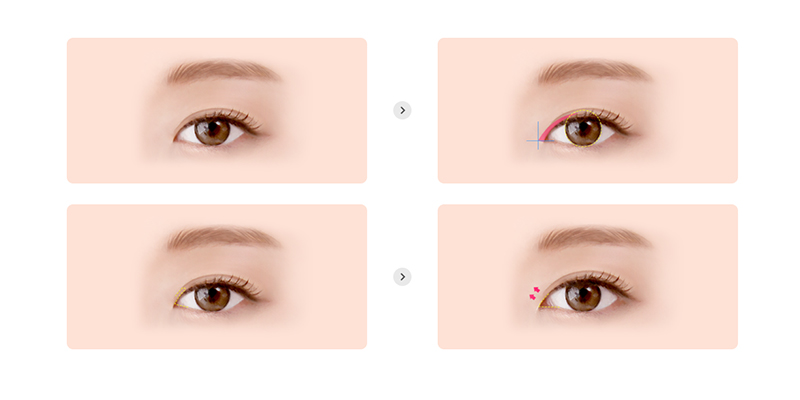 8 Types of Eyelid Plastic Surgery In Vietnam 5 eyelid plastic surgery