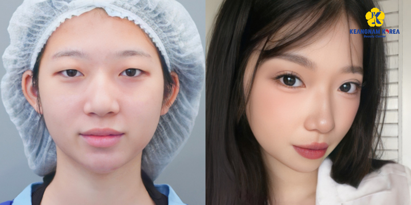 8 Types of Eyelid Plastic Surgery In Vietnam 6 eyelid plastic surgery