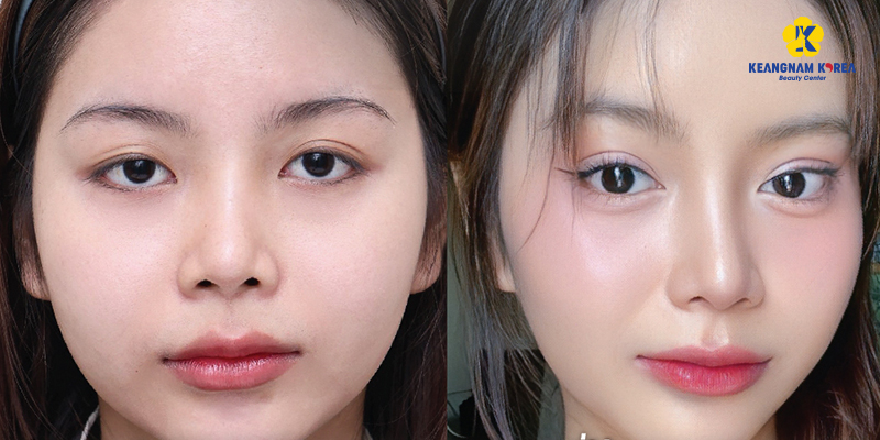 What Are Phoenix Eyes? Phoenix Eye Surgery Explained: Who Is It For? 3 phoenix eyes