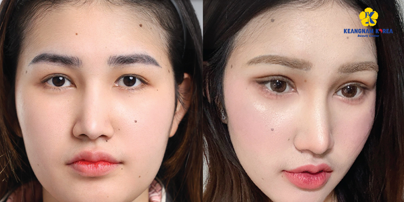 What Are Phoenix Eyes? Phoenix Eye Surgery Explained: Who Is It For? 4 phoenix eyes