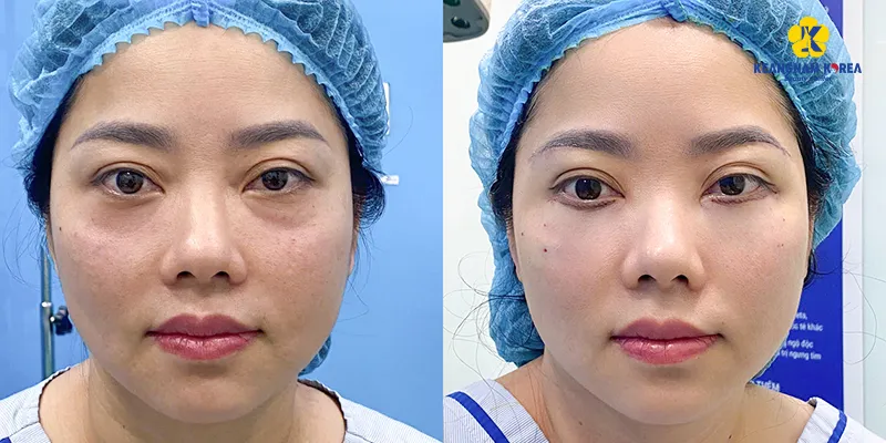 Cách làm giảm mỡ bọng mắt nhất định phải biết
