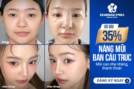 Nâng mũi bán cấu trúc