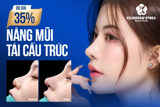 Nâng mũi tái cấu trúc