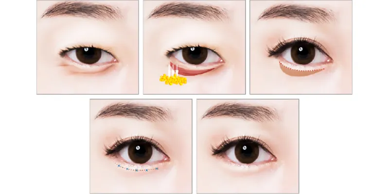 Đâu là cách khắc phục bọng mắt dưới hiệu quả nhất