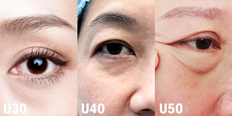 Đâu là cách khắc phục bọng mắt dưới hiệu quả nhất