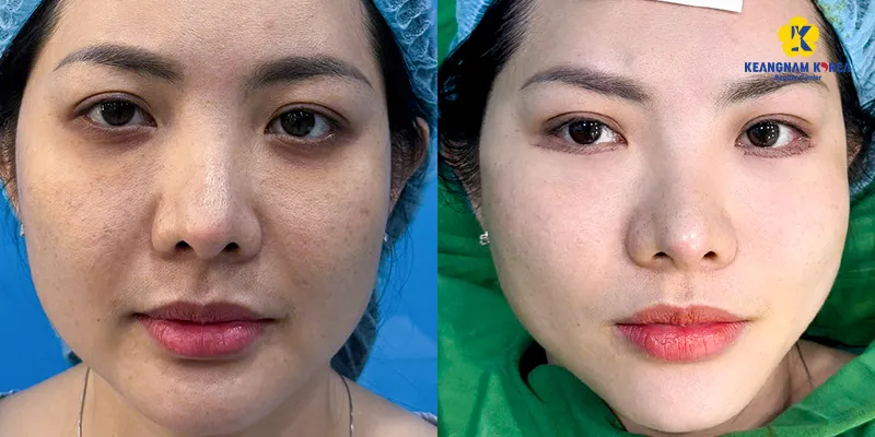 Cách làm giảm mỡ bọng mắt nhất định phải biết
