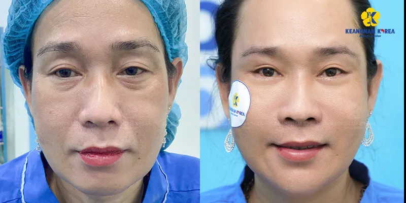 Cách xử lý bọng mắt dưới